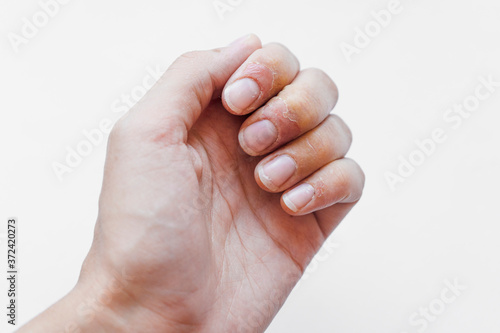 Psoriatic nail disease and psoriatic skin plaques on hands of a patient with psoriasis. Psoriasis is an autoimmune disease that affects the skin cause skin inflammation red and scaly, with signs 