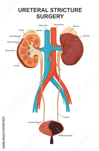 Ureteral stricture surgery. The structure of the kidneys, the adrenal gland and the bladder