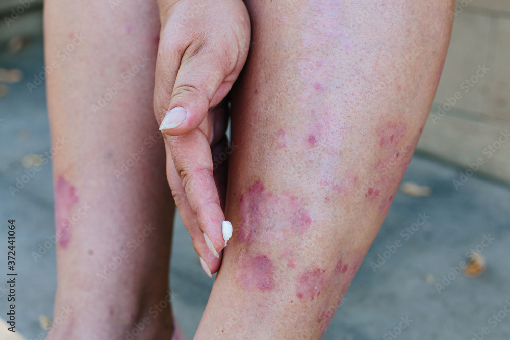 Application of therapeutic ointment for allergic rashes on the leg ...