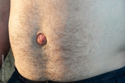 Umbilical hernia. Men's belly with a large bulging belly button