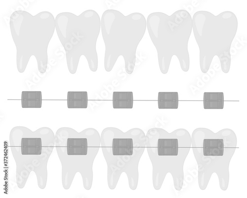 Orthodontic set of jaws with teeth with braces vector illustration