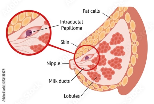 Solitary Intraductal Papilloma. tumor located within breast ducts. Close up view. Medical vector illustration marked with lines