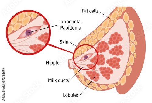 Solitary Intraductal Papilloma. tumor located within breast ducts. Close up view. Medical vector illustration marked with lines photo