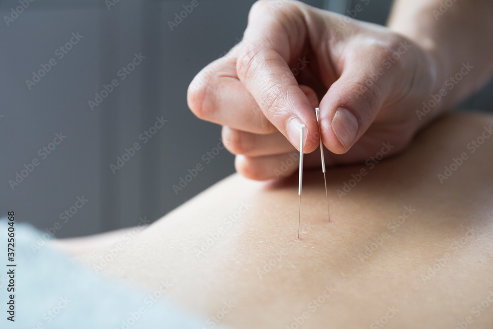 Close up acupuncturist applying acupuncture needles to woman?s back Close up acupuncturist applying acupuncture needles to woman?s back