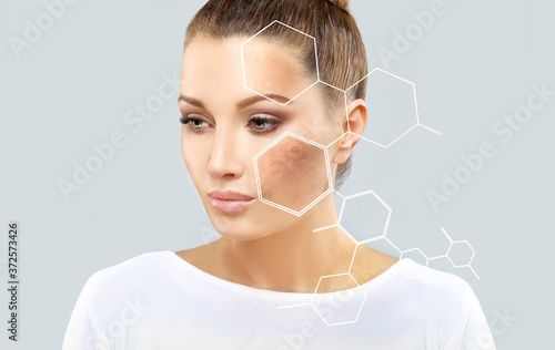 Dark spots, freckles,hyperpigmentation(melasma or chloasma),concept- skin lightening, skin whitening, Skin Brightening	
 photo