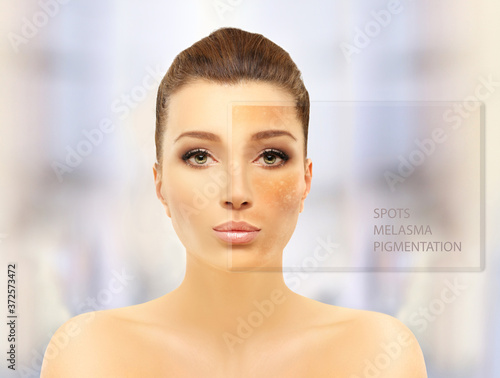 Dark spots, freckles,hyperpigmentation(melasma or chloasma),concept- skin lightening, skin whitening, Skin Brightening 