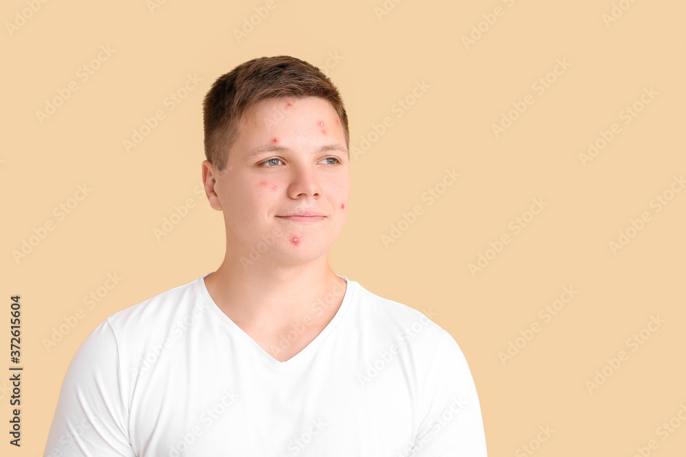 Fototapeta premium Teenage boy with acne on color background