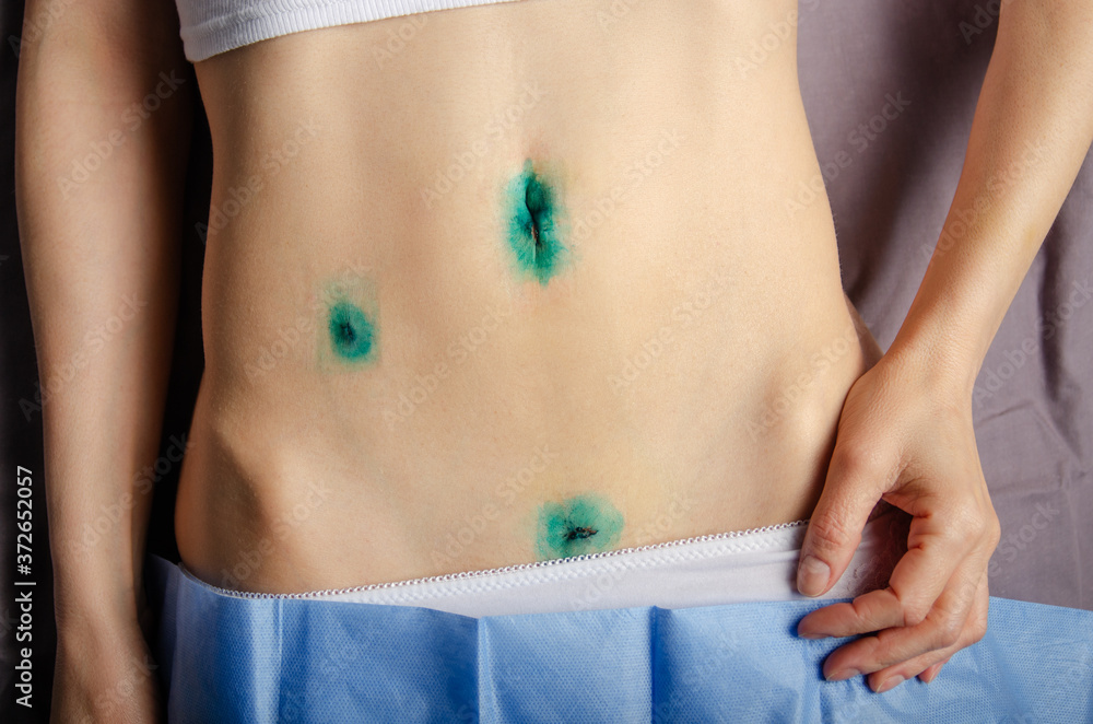 Middle age caucasian female shows her Healing scars after Laparoscopic