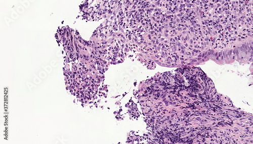 Erosion of the colon - microscopic image 20x photo