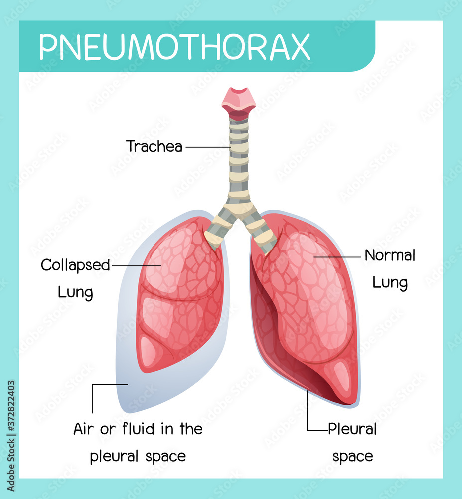 Pneumothorax cartoon of human anatomy Pneumothorax cartoon of human anatomy