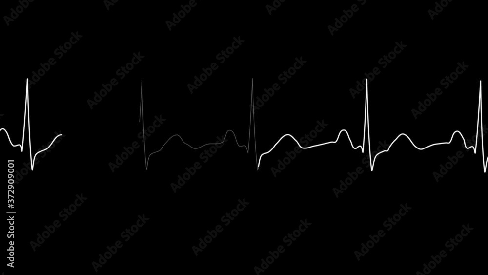 PNG Alpha.Cardiogram monitor.Looping ECG.Normal Sinus Rhythm.Heart rate. Heart beat line template.Technological HUD for medicine and science,Medical Institute students.Type 2 PNG Alpha.Cardiogram monitor.Looping ECG.Normal Sinus Rhythm.Heart rate. Heart beat line template.Technological HUD for medicine and science,Medical Institute students.Type 2