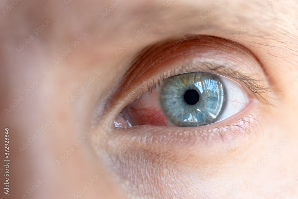 male inflamed eye with red capillaries male inflamed eye with red capillaries