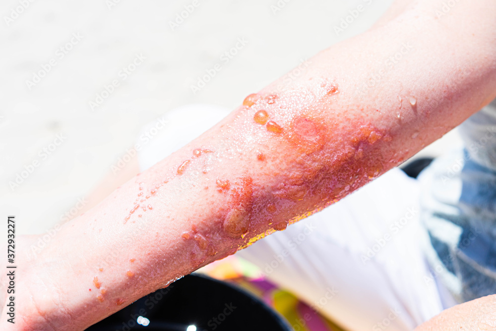 Severe poison ivy rash and infection on arm Stock Photo Adobe Stock