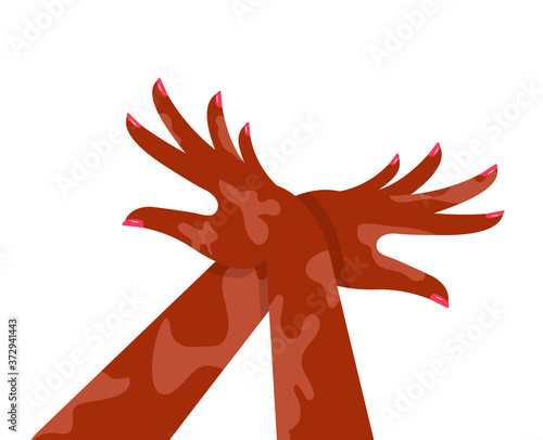 Pigmentation on a woman's hands. Beautiful manicure. Concept: a person is not ashamed of his own shortcomings. Vector illustration, flat cartoon design, isolated on white background, eps 10.