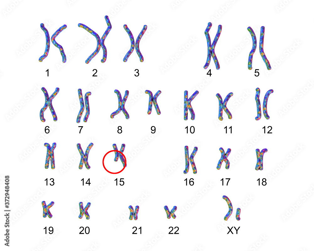 Karyotype of Angelman syndrome
