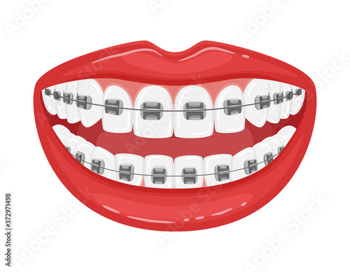 Open mouth with braces on the teeth. Straight white teeth with red lips. Orthodontic treatment.Detailed design element for booklets and flyers.Smile. Isolated on white. Flat style. Vector illustration