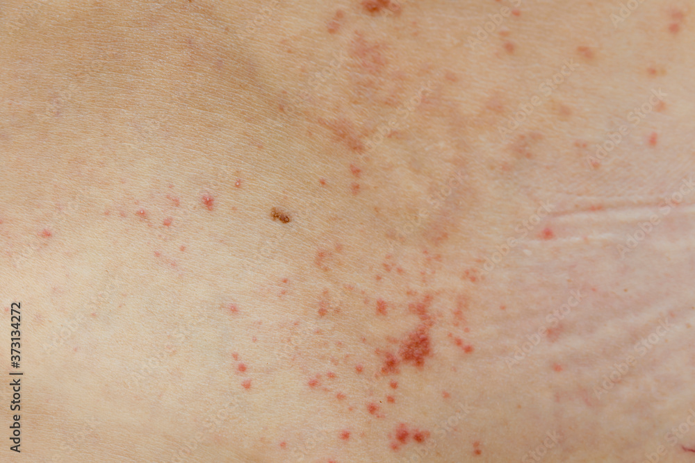 Skin disease prickly heat rash or miliaria on back skin of asian woman