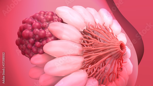 Canvastavla Breast Cancer, Breast anatomy, Growing tumor
