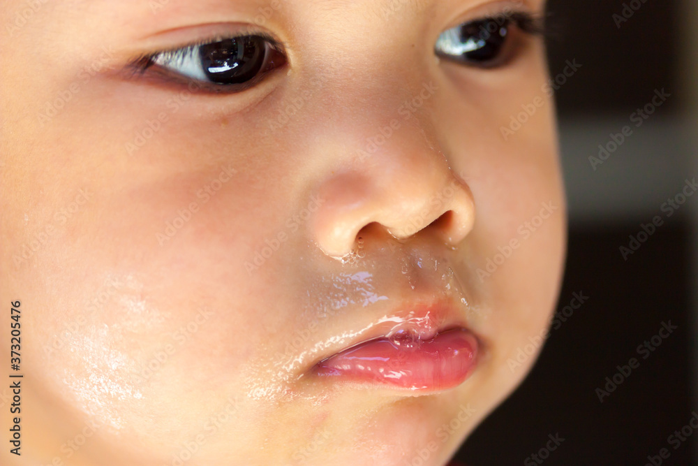 Naklejka premium sickness Asian baby boy face
