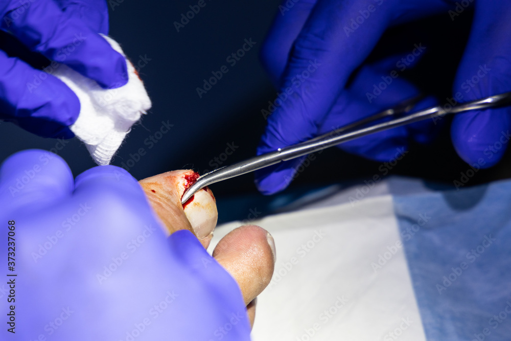 Foto de Series of ingrown toenail treatment. Medical doctor cut and