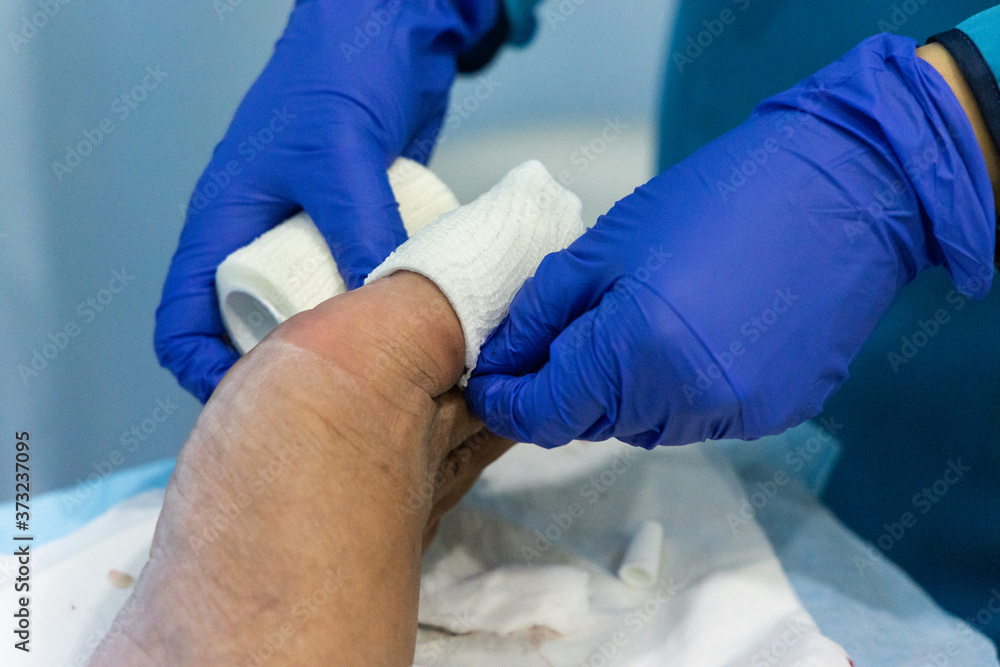 Healthcare worker nursing toe with bandage gauz after ingrown toenail surgery Healthcare worker nursing toe with bandage gauz after ingrown toenail surgery