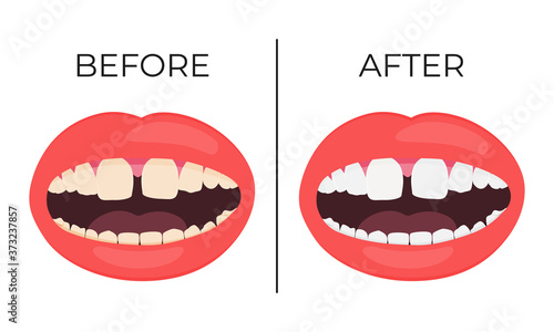 Woman lips with before and after view of whitening teeth vector illustration.