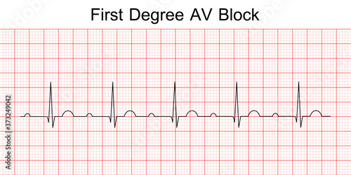 Electrocardiogram show first degree AV block pattern. ECG. EKG. Vital sign. Heart beat. Life line. Medical healthcare symbol.