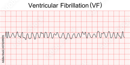 Electrocardiogram show ventricular fibrillation (VF) pattern. Cardiac fibrillation. Heart beat. CPR. ECG. EKG. Vital sign. Life support. Defib. Emergency. Medical healthcare symbol. photo