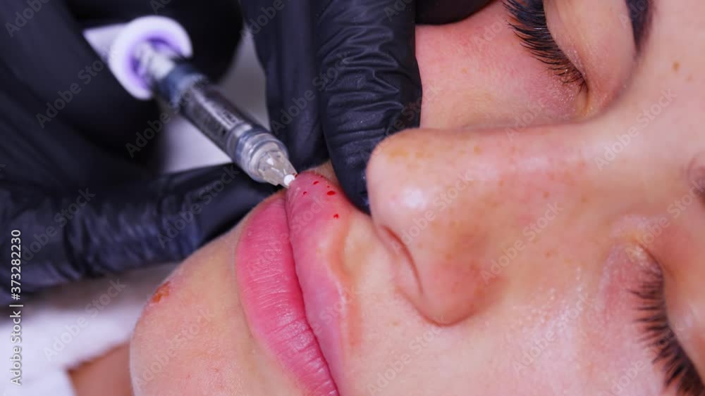 close-up, female face. Surgeon, in medical gloves, pierces upper womans lip with syringe and slowly injects hyaluronic acid. lip augmentation procedure. Plastic surgery. close-up, female face. Surgeon, in medical gloves, pierces upper womans lip with syringe and slowly injects hyaluronic acid. lip augmentation procedure. Plastic surgery.