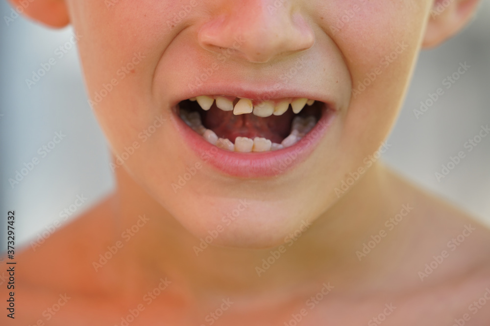 Child with milk tooth ready to fall Child with milk tooth ready to fall