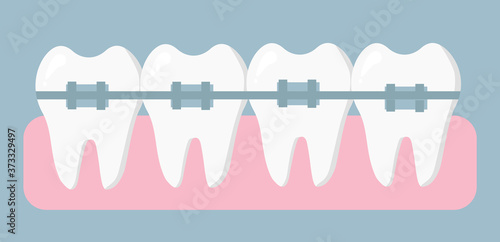 Orthodontic treatment. Braces on your teeth. Concept of dentistry and medicine. Vector illustration in a flat design.