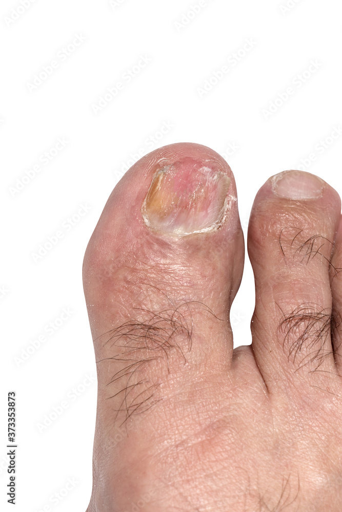 View of a big toenail infected with toe fungus after lacquer - polish application.
