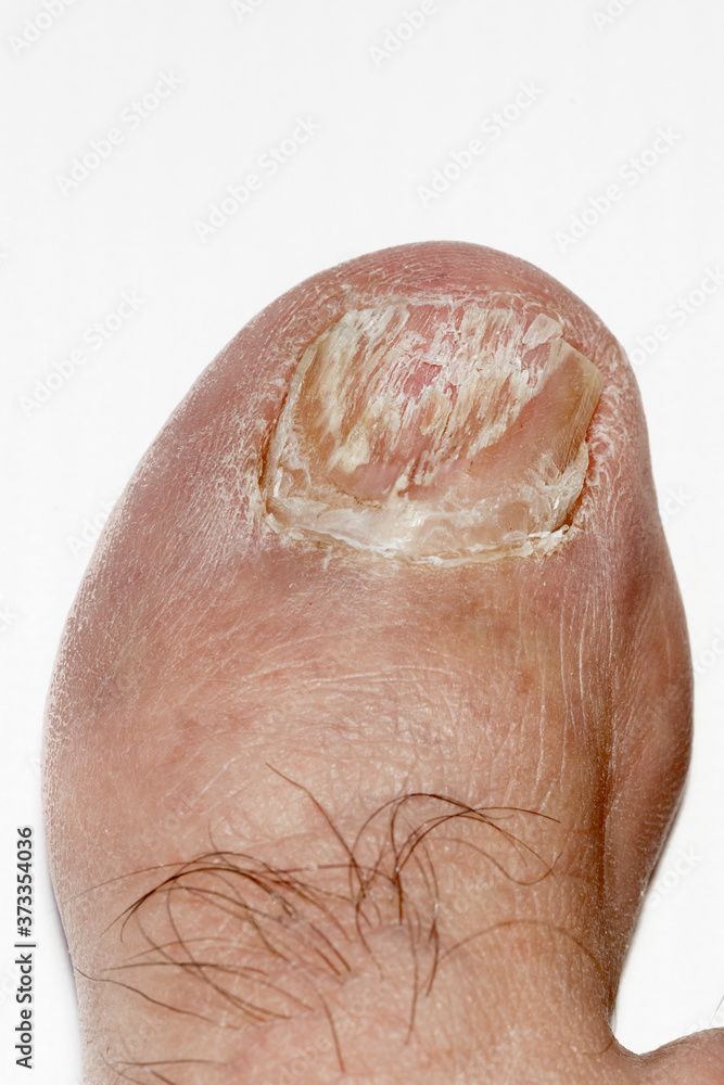 Big toe nail with Onychomycosis, a fungal infection causing yellowing