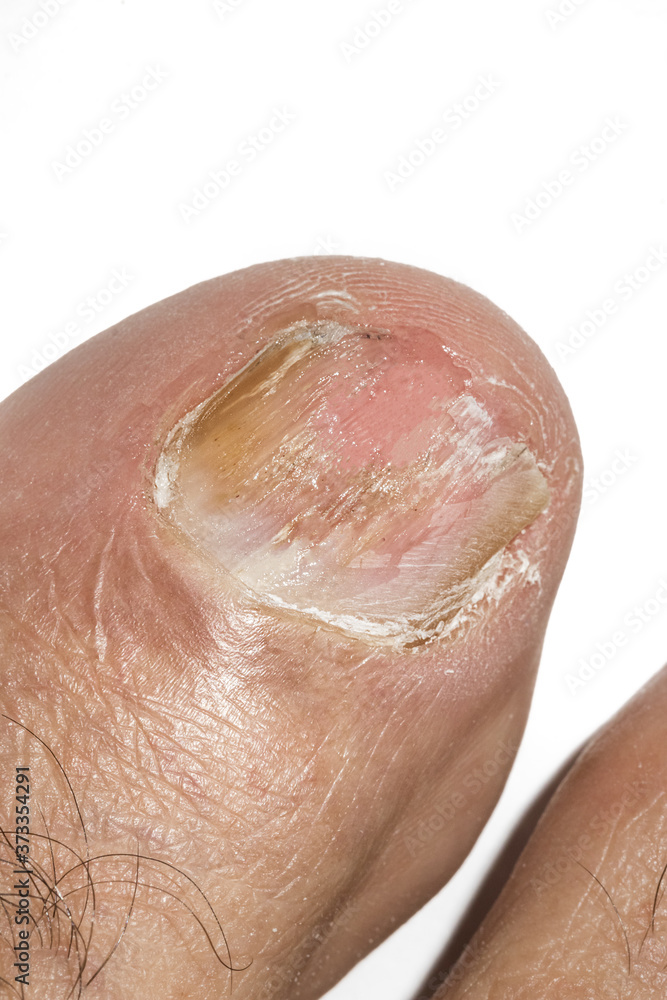 Macro photography of Big toe nail with Onychomycosis, a fungal infection causing yellowing of the toenail. Macro photography of Big toe nail with Onychomycosis, a fungal infection causing yellowing of the toenail.