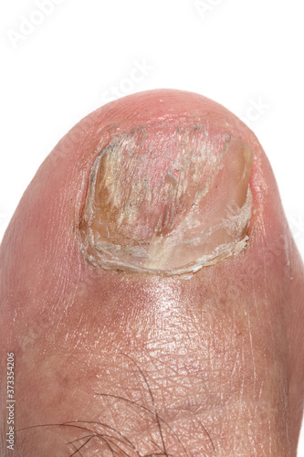 Macro photography of Big toe nail with Onychomycosis, a fungal infection causing yellowing of the toenail.