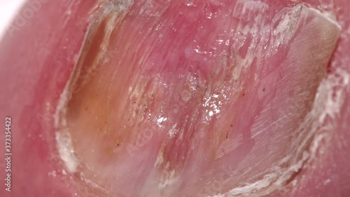 Macro photography of Big toenail with Onychomycosis, a fungal infection causing yellowing of the toenail.