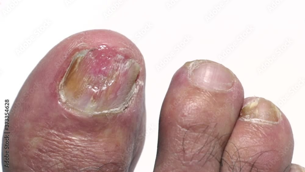 Panning of a big toenail with Onychomycosis, a fungal infection causing