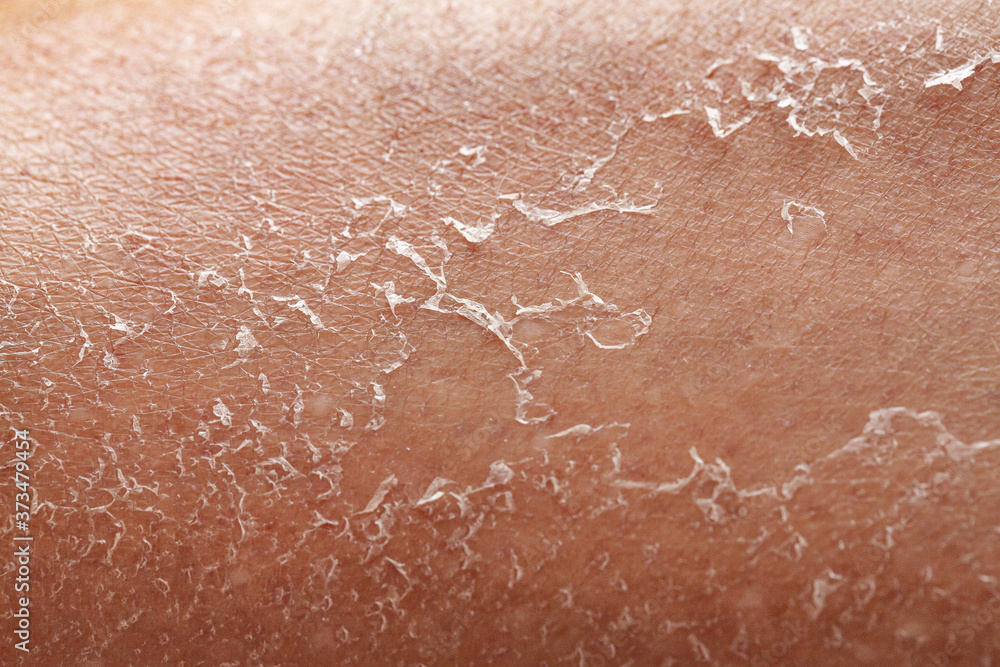 Fototapeta premium Details of a woman's dry skin. Exfoliation after dehydration due to exposure to sunlight