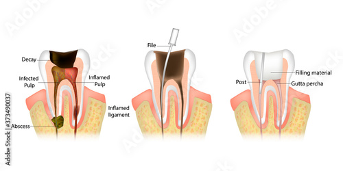 Endodontic root canal treatment process. photo