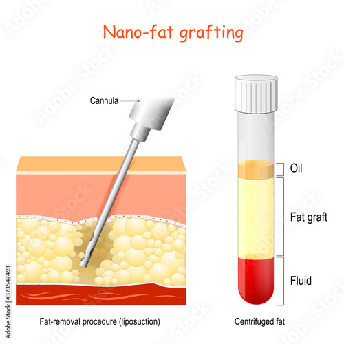 Liposuction and Nano-Fat grafting