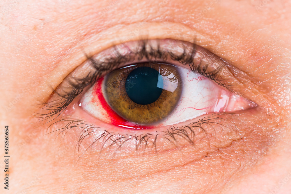 Fototapeta premium Detail of woman brown eye with the damage and blood in eye