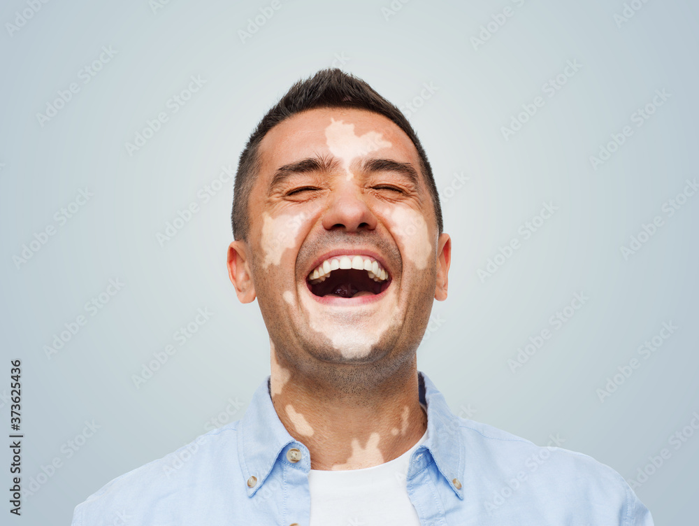 diversity, skin pigmentation and people concept - happy laughing man with vitiligo diversity, skin pigmentation and people concept - happy laughing man with vitiligo