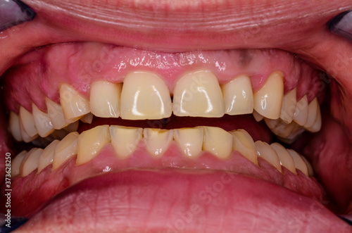results of massive teeth grinding photo