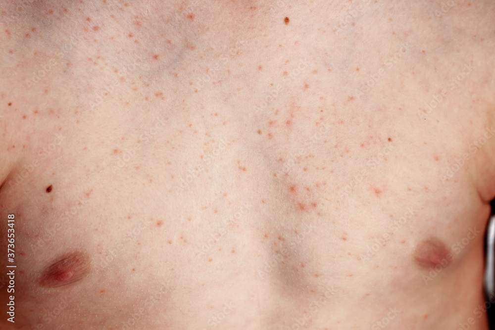 Close up image of a little boy's body suffering severe urticaria, nettle rash also called hives