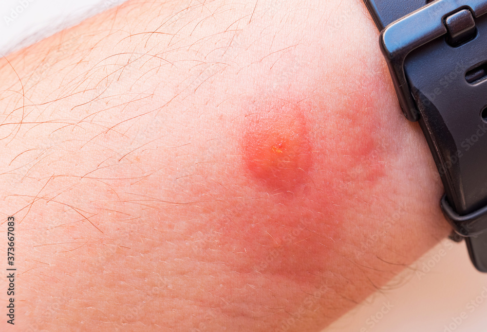 Fototapeta premium Insect bite on a men's hand. Allergic reaction.