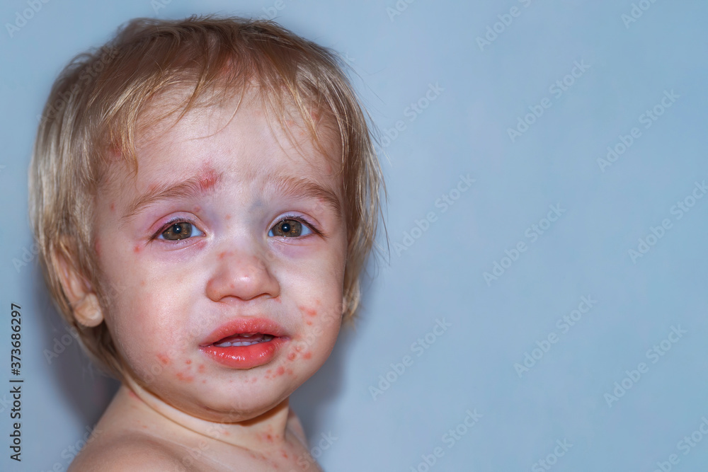 Chickenpox disease, with fever and runny nose. Boy sick on his face. Chickenpox virus, chicken