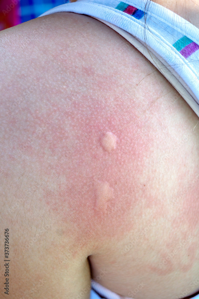 Fototapeta premium Girl with multiple mosquito bites