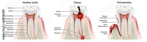 Bild auf Leinwand Healthy tooth, caries and periodontitis, meidically illustration