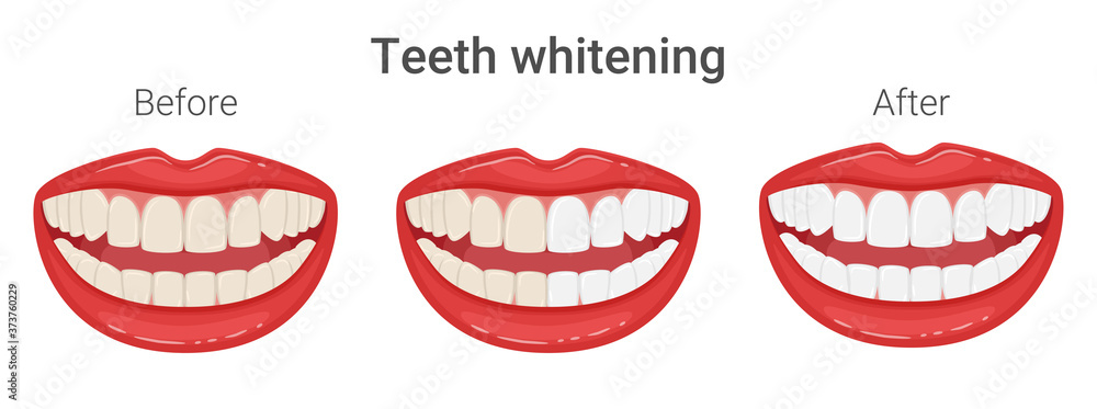 Even yellow and white teeth in the mouth. Teeth whitening. Mouth in a smile. Aesthetic dentistry. Comparison before and after. Healthy lifestyle, dental care. Isolated flat vector illustration Even yellow and white teeth in the mouth. Teeth whitening. Mouth in a smile. Aesthetic dentistry. Comparison before and after. Healthy lifestyle, dental care. Isolated flat vector illustration