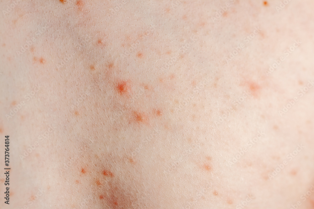 Close up image of a little boy's body suffering severe urticaria, nettle rash also called hives